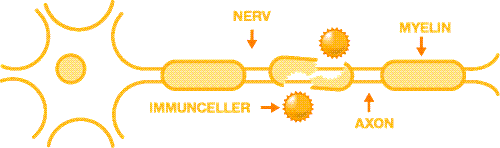 Bild som föreställer vad som händer med nervcellerna under ett MS-skov