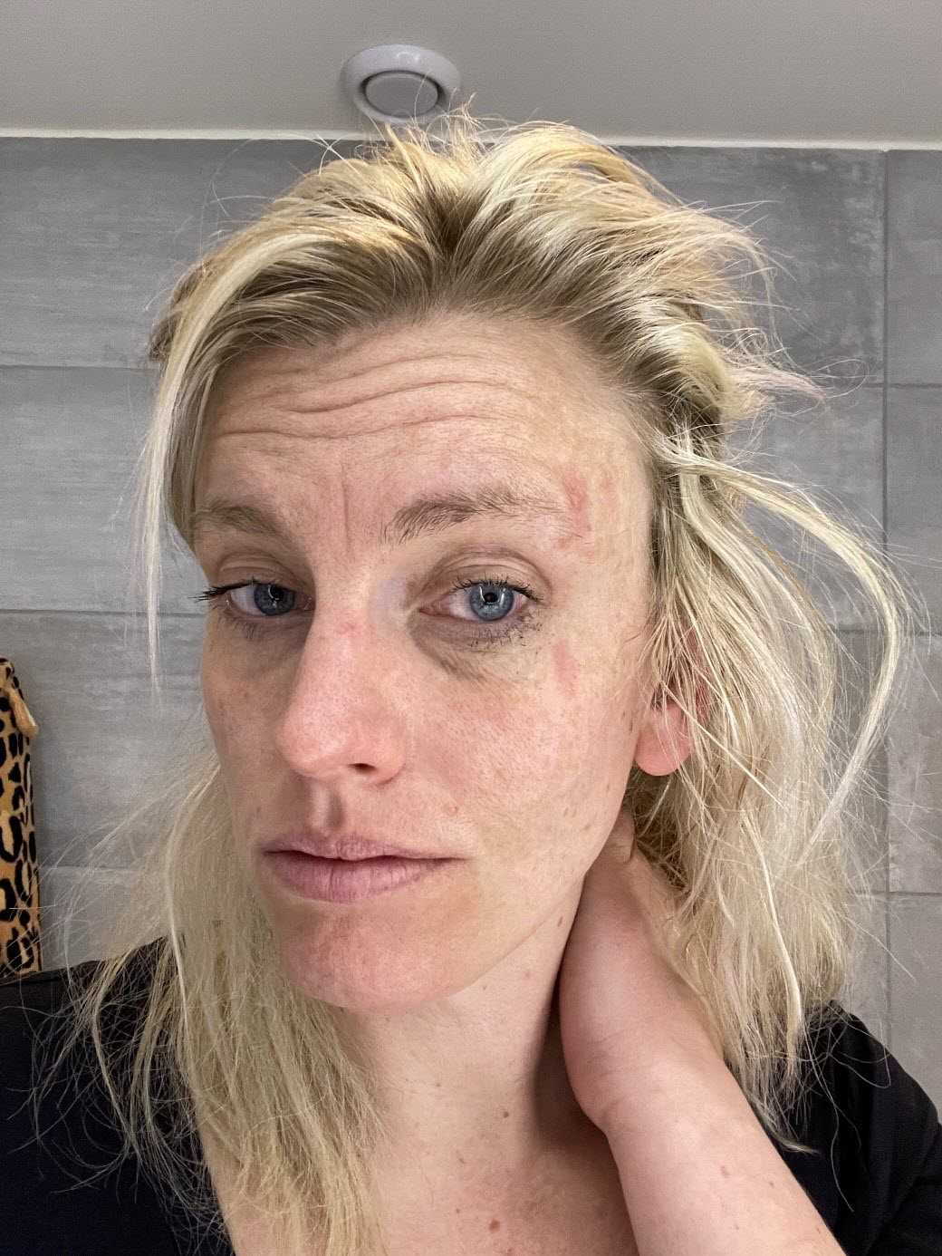 Linda om märkliga symtom vid MS.