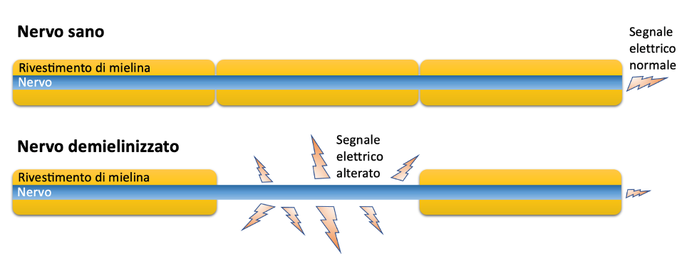 Demielinizzazione