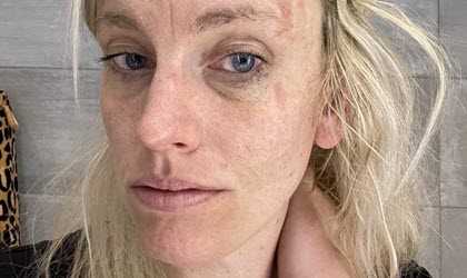 Linda bloggar om märkliga symtom vid MS.