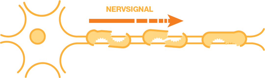 Nervsignalerna tar sig fram långsammare eller inte alls.