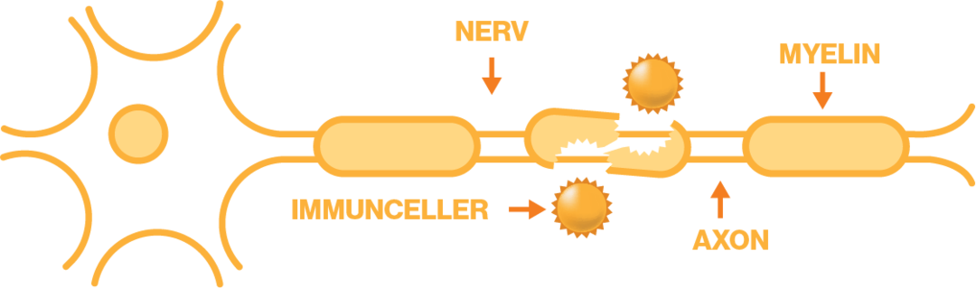 Bild som föreställer vad som händer med nervcellerna under ett MS-skov.