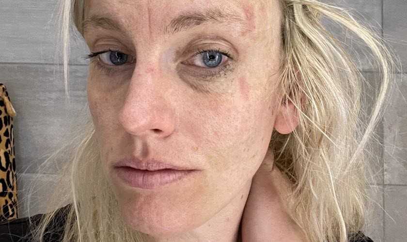 Linda skriver om märkliga symtom vid multipel skleros (MS)